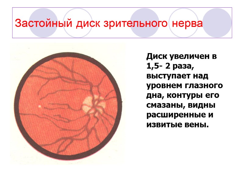 Застойный диск зрительного нерва Диск увеличен в 1,5- 2 раза, выступает над уровнем глазного